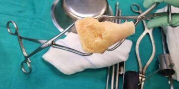 First bone graft on Lanzarote