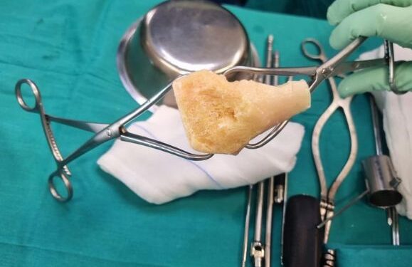 First bone graft on Lanzarote
