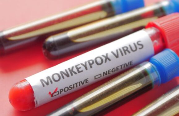 First confirmed case of Monkeypox on Lanzarote