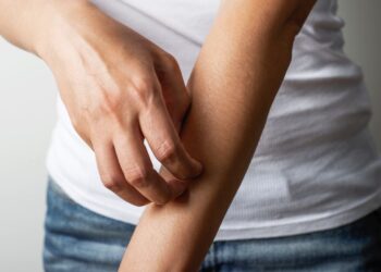 Sanidad detects two outbreaks of scabies in January