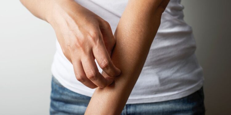 Sanidad detects two outbreaks of scabies in January
